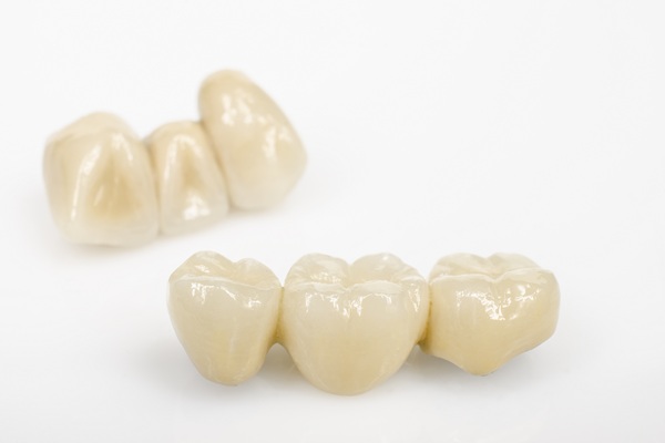 Why Dental Bridges Are Still A Smart Choice