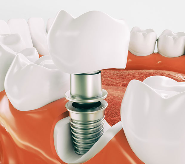 Stockton Dental Implant Restoration