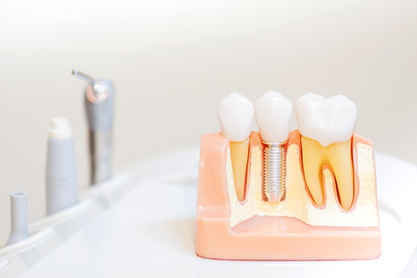 Dental Implants: A Solution For Missing Teeth