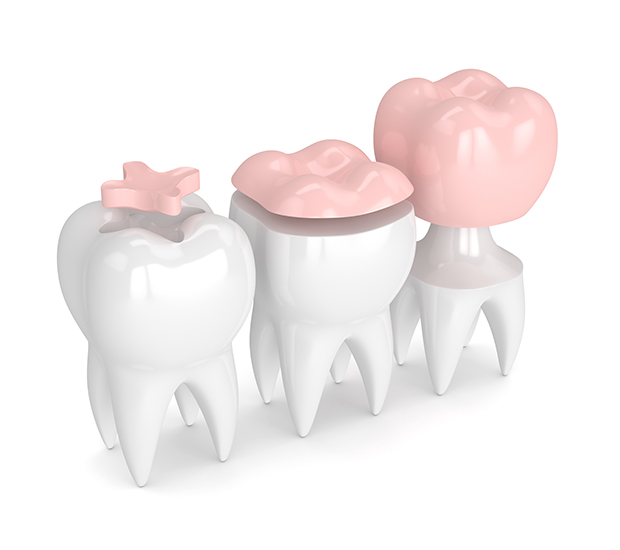 Stockton Dental Inlays and Onlays