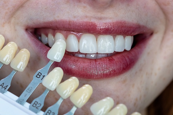 Questions To Ask Before Getting Dental Veneers