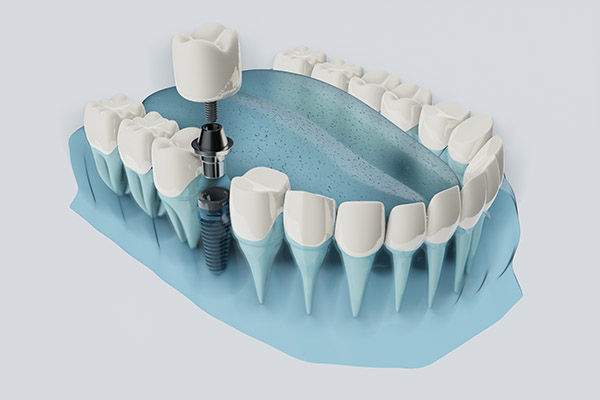 FAQs About Dental Implants