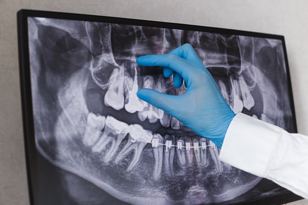 When Do I Need A Root Canal?