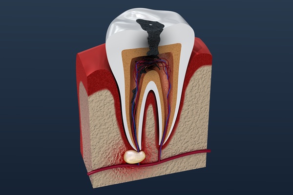 What’s The Difference Between A Root Canal And A Filling?