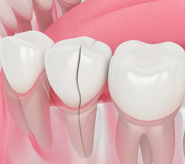 Stockton Types of Dental Root Fractures