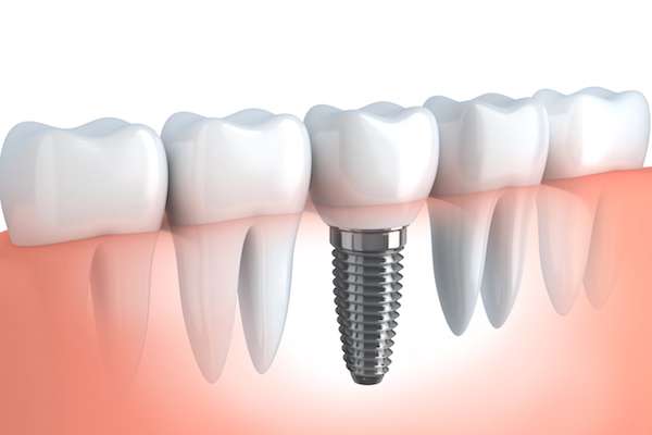 Your Ultimate Guide to Getting Dental Implants from Martin Dentistry in Stockton, CA